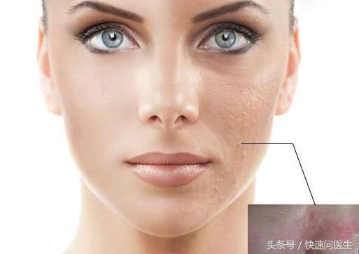 痘坑怎么修复点阵激光成都,为什么激光可以修复痘坑