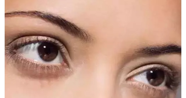 和阿姨的双眼皮做的太宽失败了