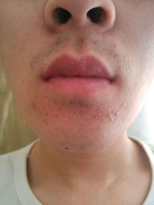 消了又长的疮是什么疮,脸部长疮的症状和治疗方法