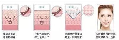 雀斑真的可以用激光彻底祛除吗,激光祛除雀斑的利弊大揭秘