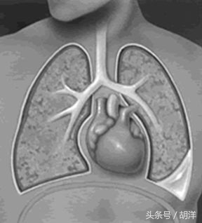 胸腔积液怎么治才能除根,胸腔积液怎么治才能彻底除根