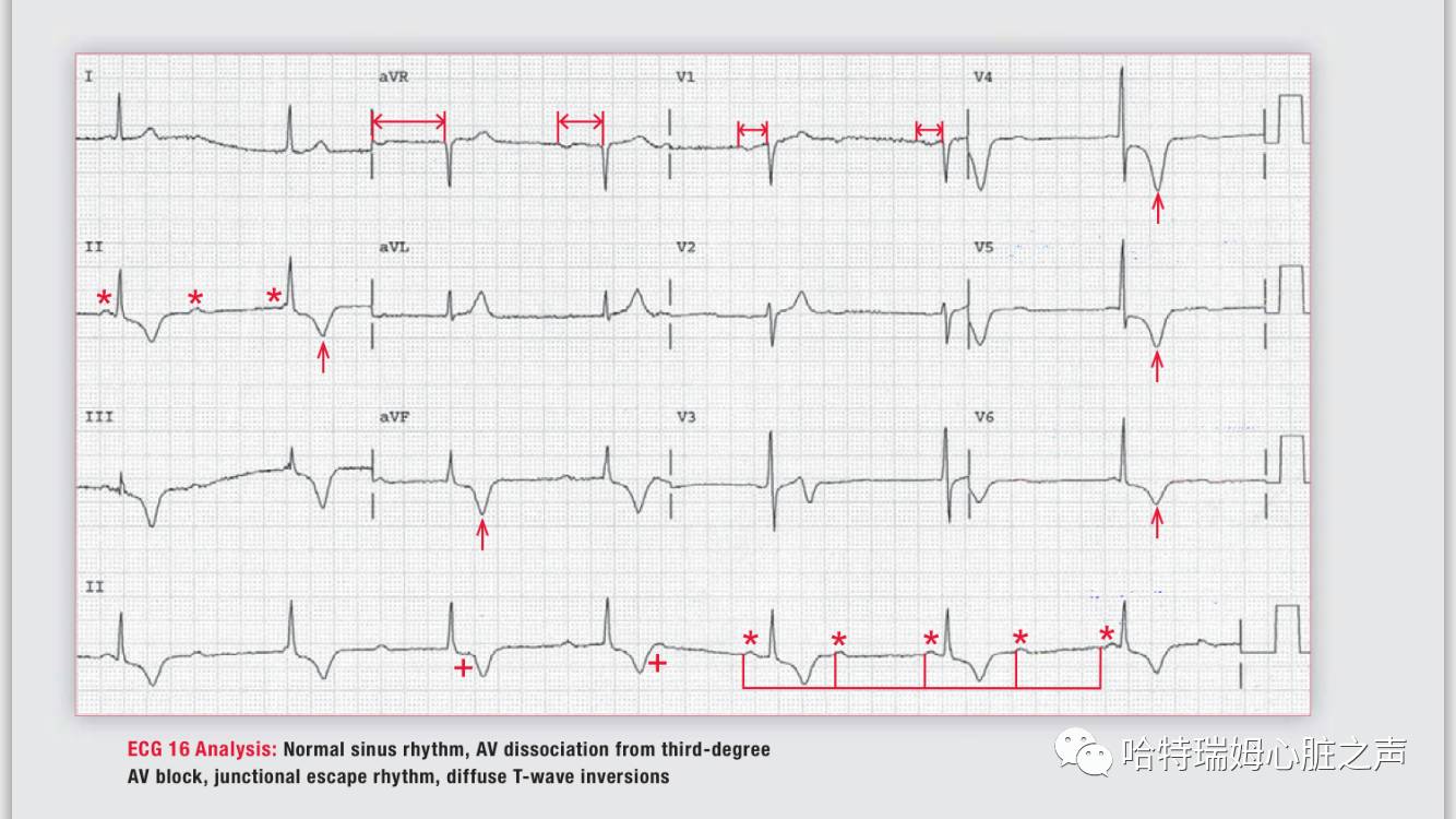 「读心有术」057期：这么多的T波倒置，该怎样诊断？