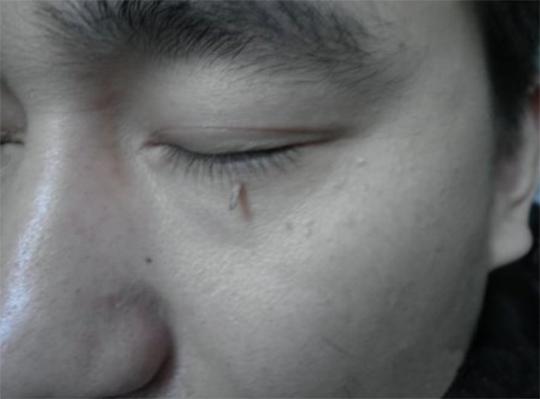 身上长小肉疙瘩有啥危害,身上长了小肉疙瘩能治愈吗