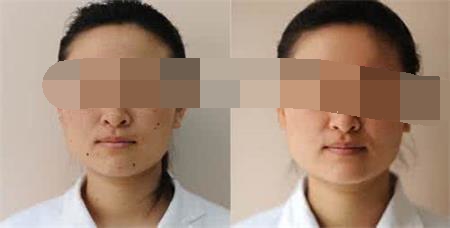 激光祛雀斑恢复后注意什么,激光去雀斑能干净吗