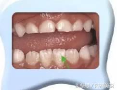 换牙期间怎么做才能让牙齿长整齐,小孩牙齿长得太疏换牙会丑吗
