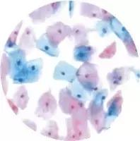 宫颈巴氏涂片和tct哪个准,宫颈癌筛查到底做tct还是hpv