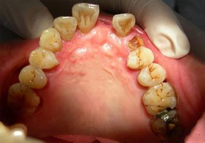 你知道缺牙的后果有多严重吗,你真的知道缺牙的危害