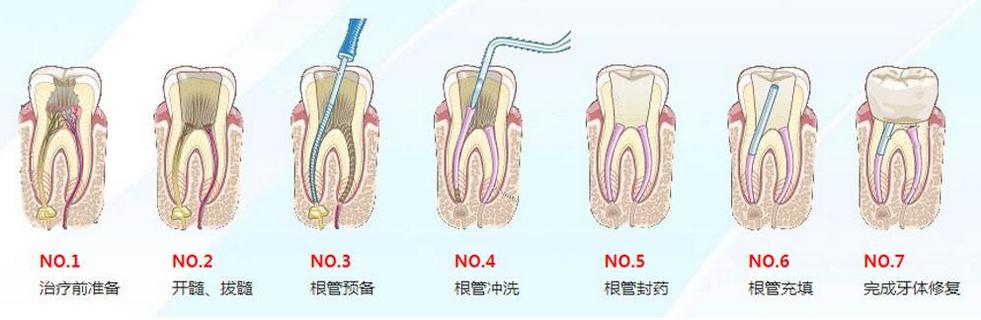 补牙跟根管治疗之间不得不说的故事