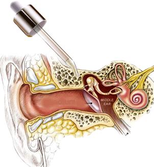 化脓性中耳炎基本知识