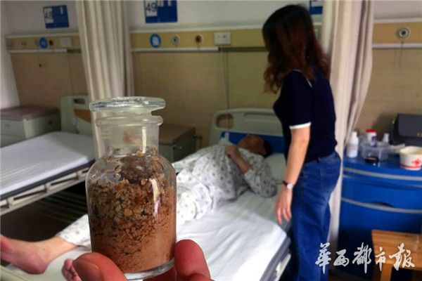 男子结石取出1200颗石头,有结石经常做体外碎石