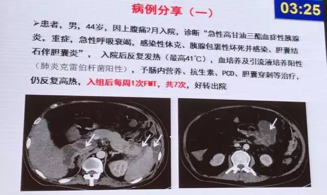 胰腺炎和胆囊炎吃什么消炎药,急性胰腺炎抗生素