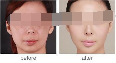激光祛雀斑恢复后注意什么,激光去雀斑能干净吗