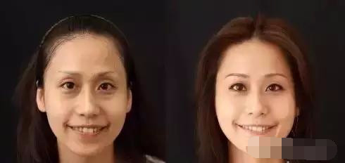 抢救假性眼纹、眼袋的黄金时间，错过你就老了