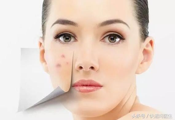 激光祛痘印的危害与效果,激光快速祛黑痘印