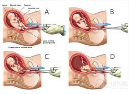 宝宝六个月被引产太可怜了,5个月不想要宝宝引产亲身经历