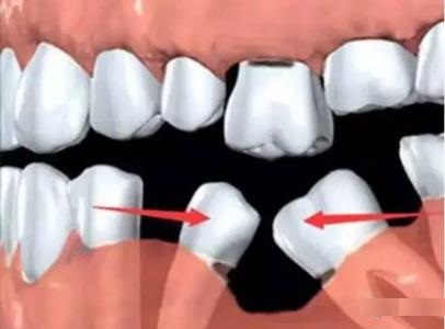 你知道缺牙的后果有多严重吗,你真的知道缺牙的危害