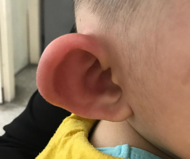 腿上被蚊子咬了留下的疤痕怎么祛,腿上被蚊子咬后留下的黑疙瘩图片