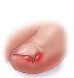 脚趾甲往肉里长很痒怎么办,大拇脚趾肉里痒怎么办