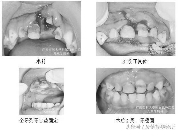 宝宝不小心磕到头有事吗,如果乳牙被磕伤了怎么办