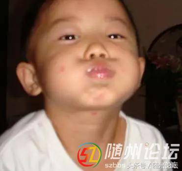 水痘传染病防控知识宣传图片,水痘传染病防控知识宣讲