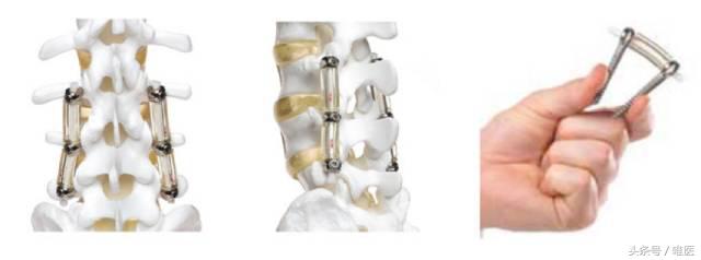 不小心把腰扭了怎么快速修复,不小心把腰扭了不太严重怎么处理