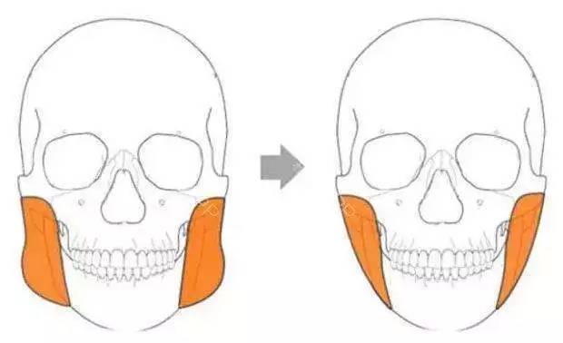 打一针水光针,打一针玻尿酸要1万多