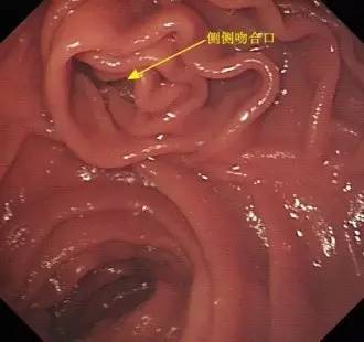 胃镜预处理流程,胃镜内镜手术全流程