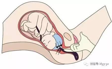 分娩前的问题,分娩必须知道的五件事