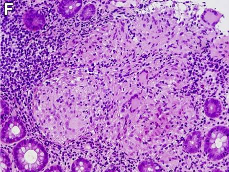 腹泻的不同类型及病例,腹泻的不同原因及现象