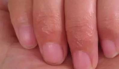 手脱皮缺什么维生素吃什么补,手脱皮是缺维生素吃什么药