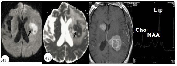 医学干货：瘤样炎性脱髓鞘病与胶质瘤、PCNSL临床、影像鉴别