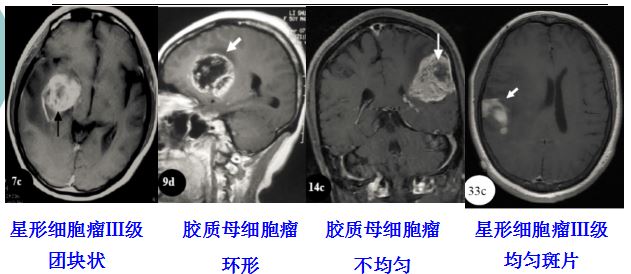 医学干货：瘤样炎性脱髓鞘病与胶质瘤、PCNSL临床、影像鉴别