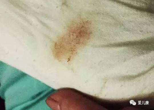 宝宝吐奶并且发烧是怎么回事,宝宝吐奶症状视频