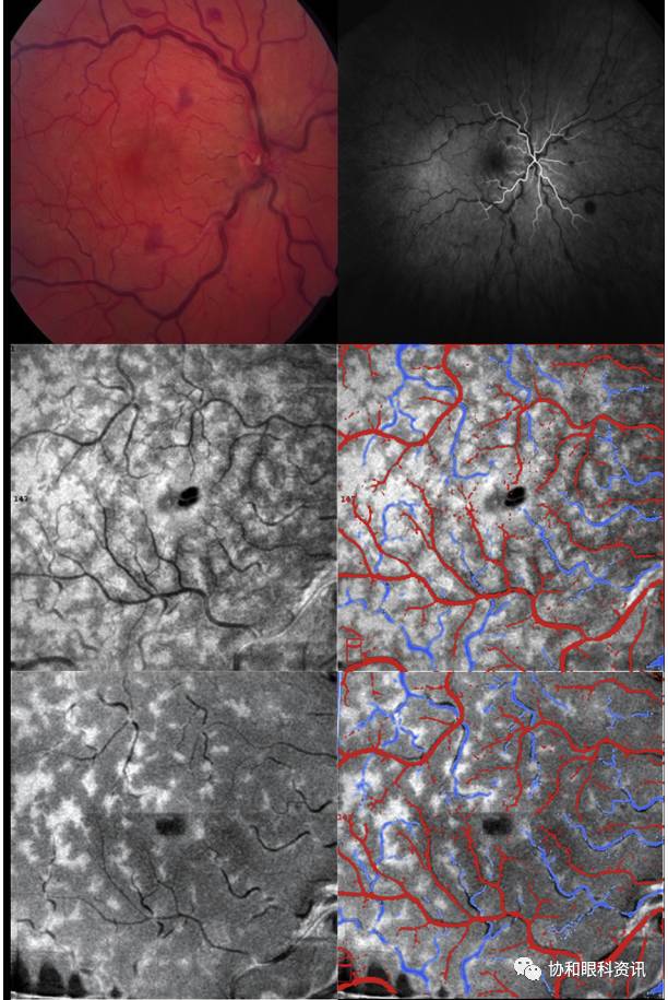 文摘速递丨横看成岭侧成峰,BC扫描各不同—PAMM的enface-OCT影像
