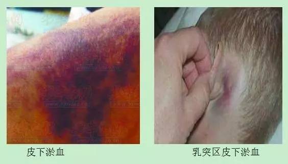 压疮久治不愈后果,身体压疮怎么治疗