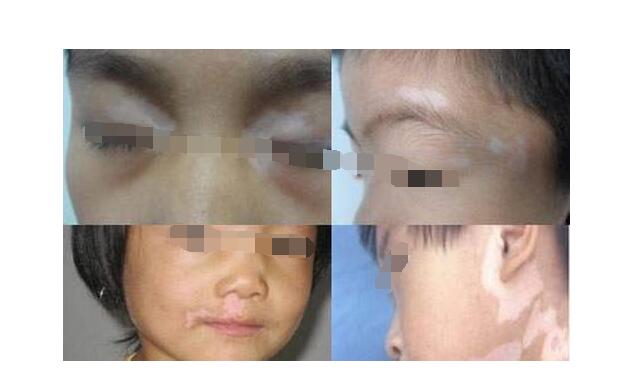 烟台半岛白癜风医院成功案例,烟台白癜风的治疗有效方法