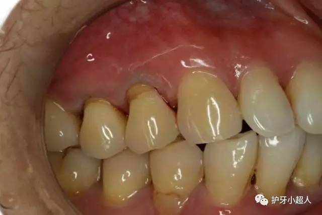 牙齿有洞但没有黑是虫牙吗,牙齿有洞不黑要补牙吗