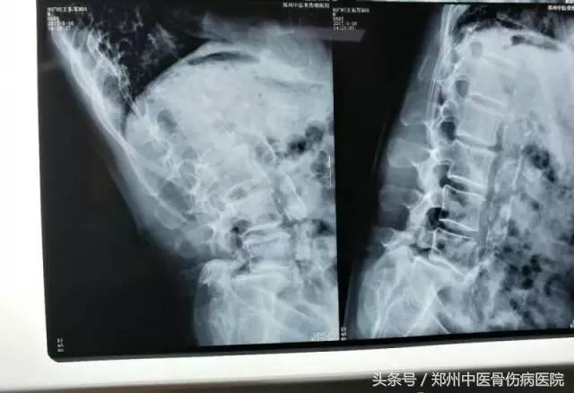 站着说话也腰疼,站着说话突然一侧腰疼