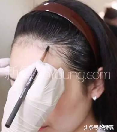 杨幂发际线还会回归吗,杨幂发际线秃到后脑勺