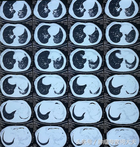 72岁老爷子，肺癌晚期，喘不上气，经这么一治疗竟然好多了