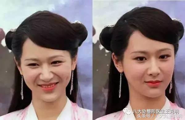 杨紫的法令纹能消除吗,杨紫法令纹很深怎么回事