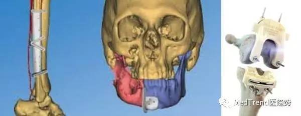全球骨科巨头之强生DePuySynthes—风云变幻