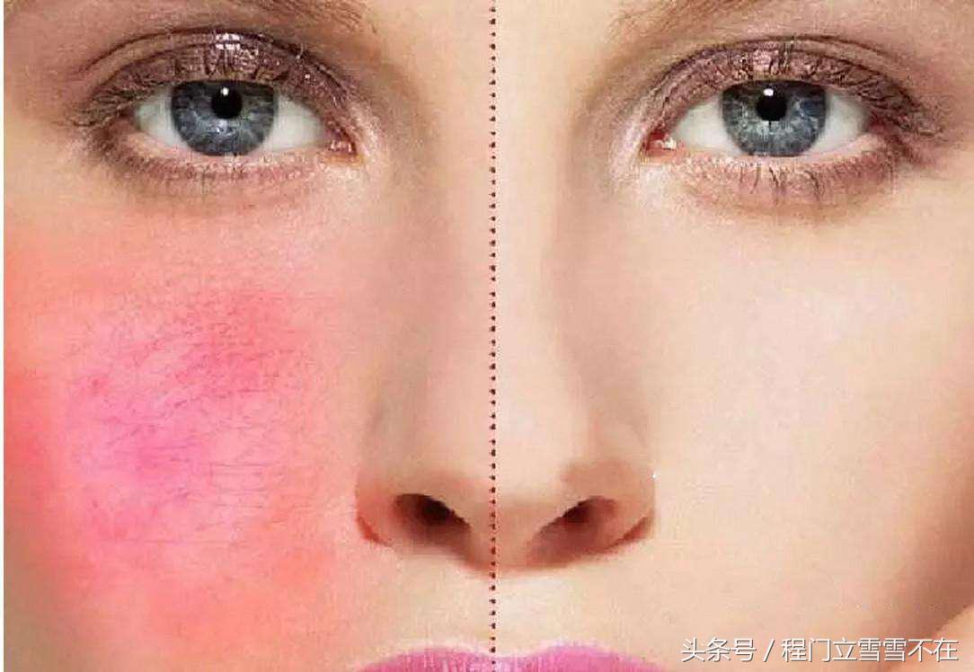 去面部红血丝最有效药,祛面部红血丝最有效的方法