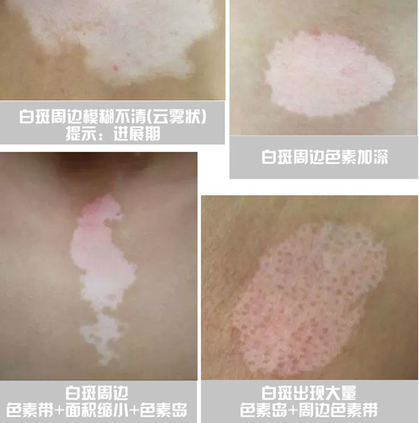 白癜风的四个初期症状,白癜风常见的20个问题