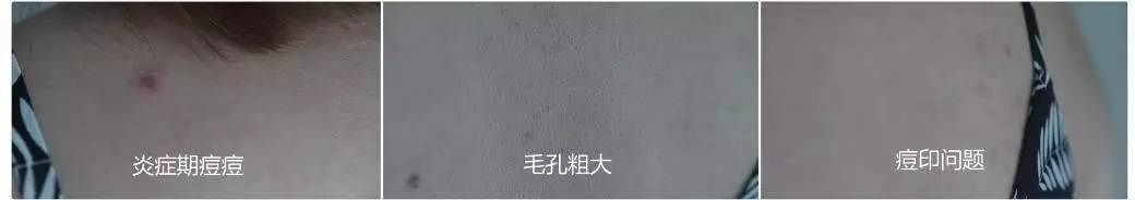 这可能是夏天穿吊带最大的烦恼……这可能是背部痘痘最全攻略