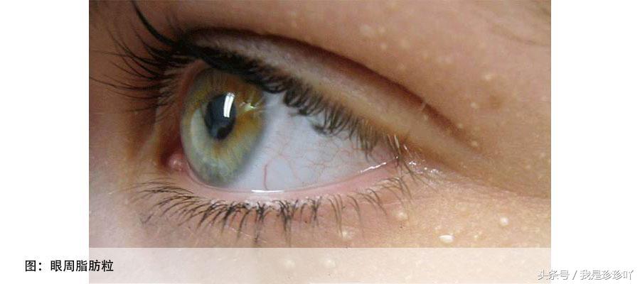 清除脂肪粒和汗管瘤的全过程,脂肪粒汗管瘤最好最快的去除方法