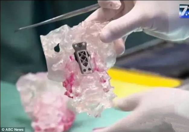 Sun资讯速递澳洲医学再次震惊全宇宙！澳洲医生完成全球首例人头分离手术！罕见癌症就这么治好了！