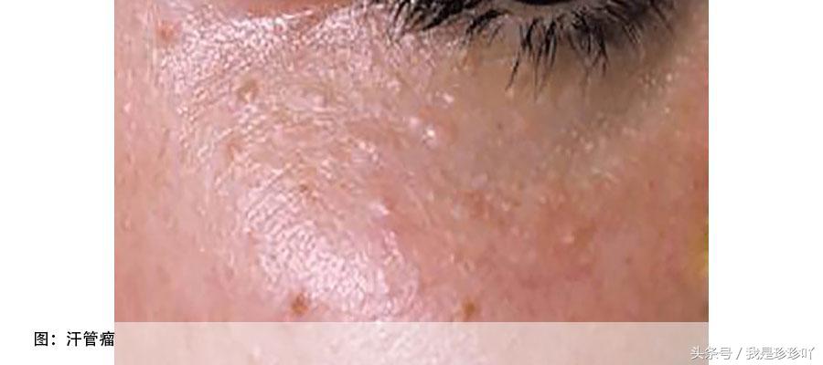 清除脂肪粒和汗管瘤的全过程,脂肪粒汗管瘤最好最快的去除方法