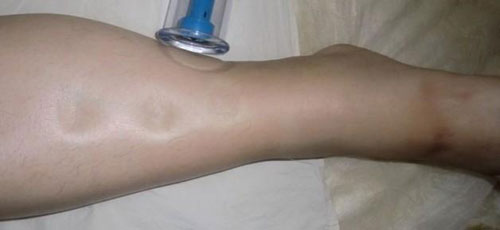 产后可以打瘦腿针吗,产后瘦腿瘦肚子视频