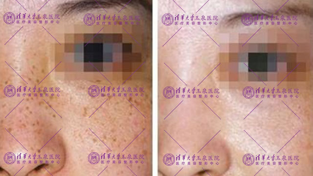 黄褐斑激光后反黑很严重怎么办,激光祛斑后反黑期间可以化妆吗